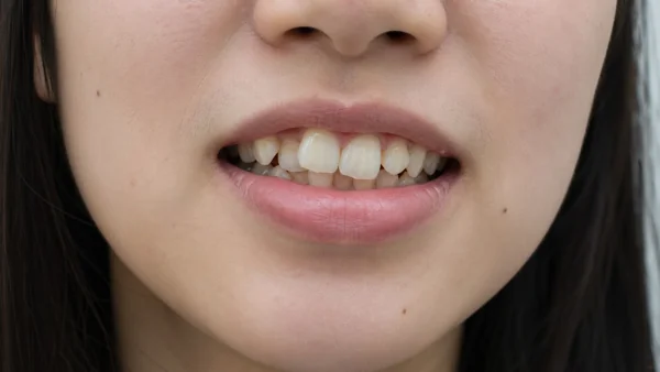 女性の口元・歯のクローズアップ